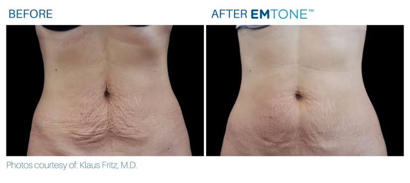 EMTONE results — Abdomen at iCRYO Port St. Lucie