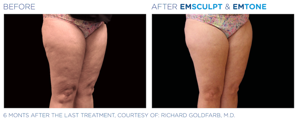 EMTONE results — Thighs at iCRYO Port St. Lucie