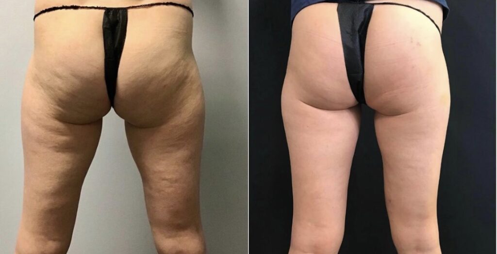 EMTONE results — Buttocks & Back Thighs at iCRYO Port St. Lucie