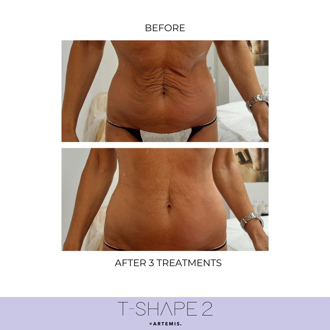 T-Shape 2 results — Abdomen at iCRYO Port St. Lucie