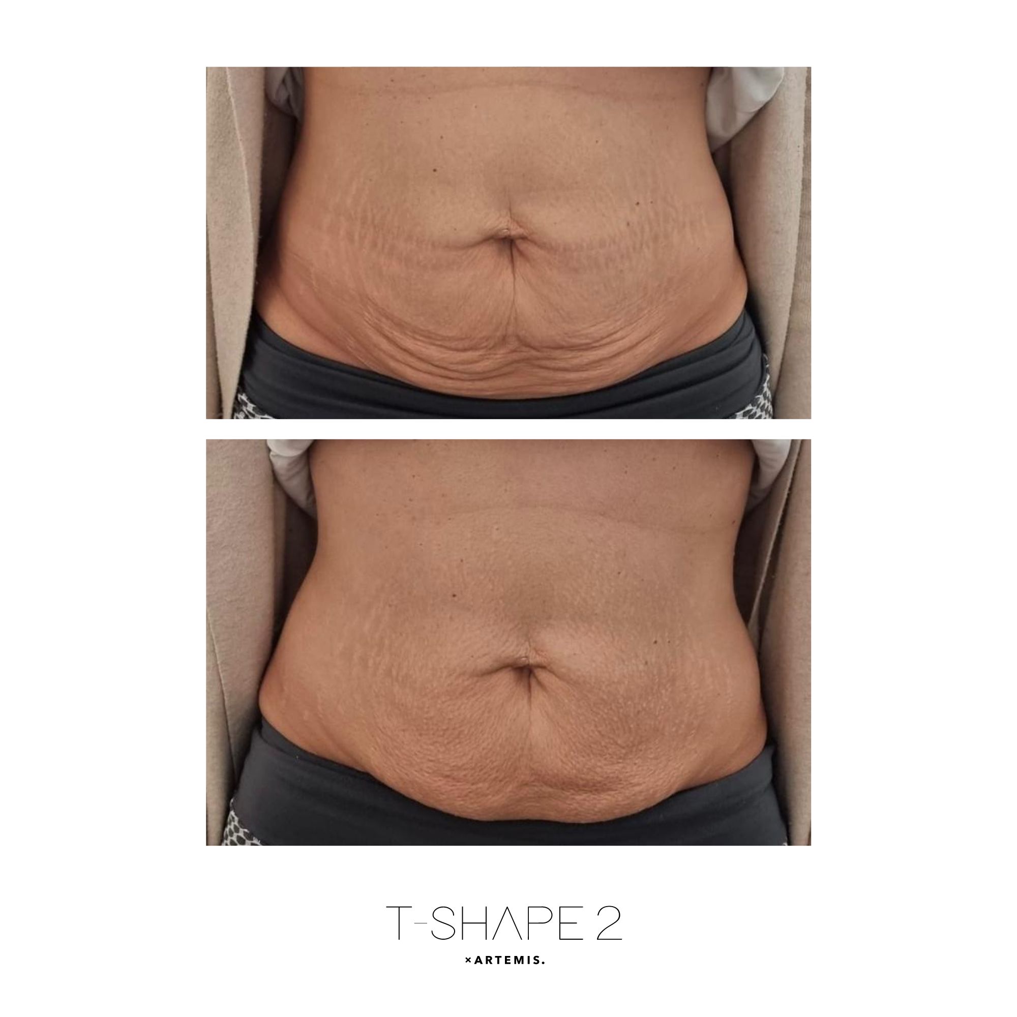 T-Shape 2 results — Abs at iCRYO Port St. Lucie