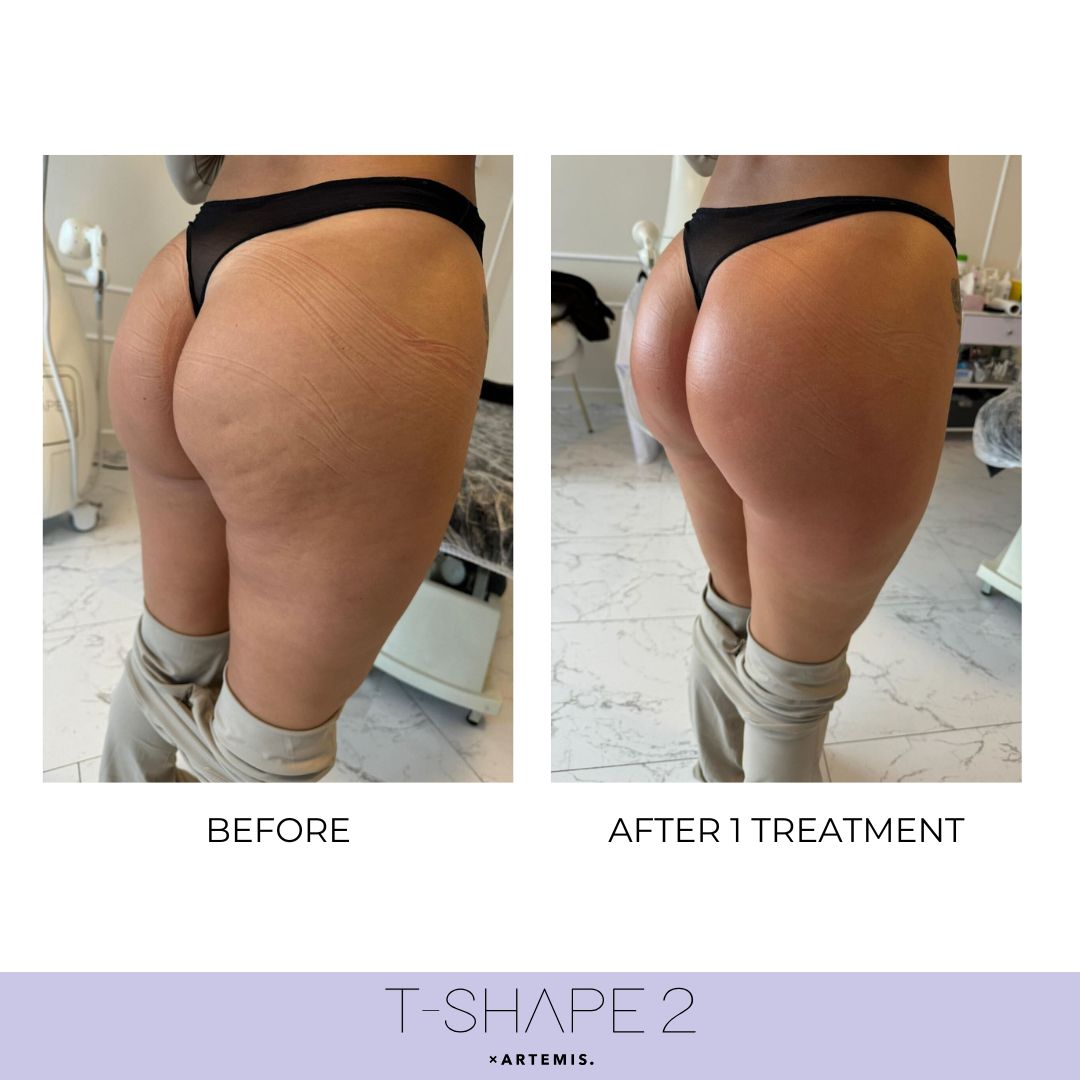 T-Shape 2 results — Body at iCRYO Port St. Lucie