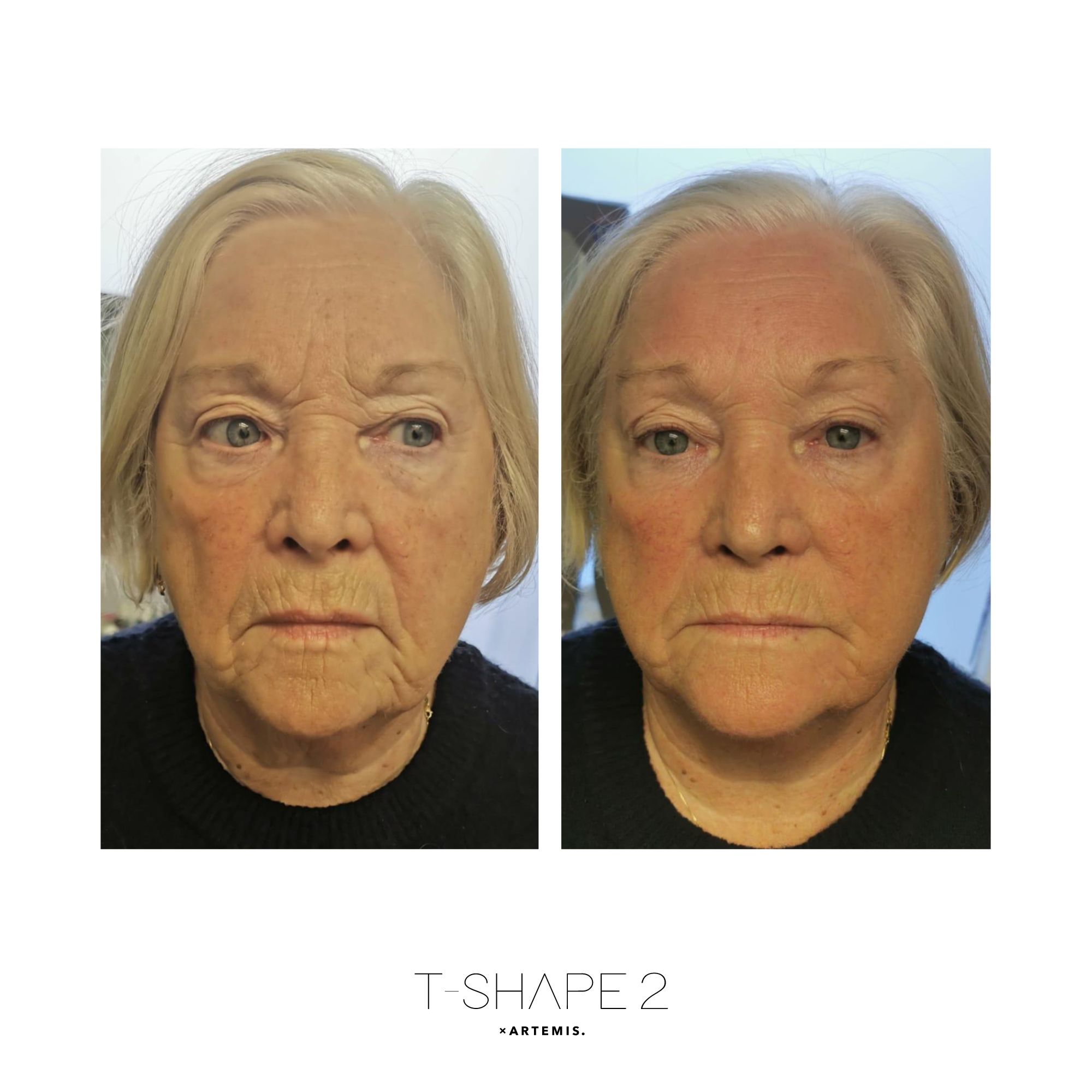 T-Shape 2 results — Face at iCRYO Port St. Lucie