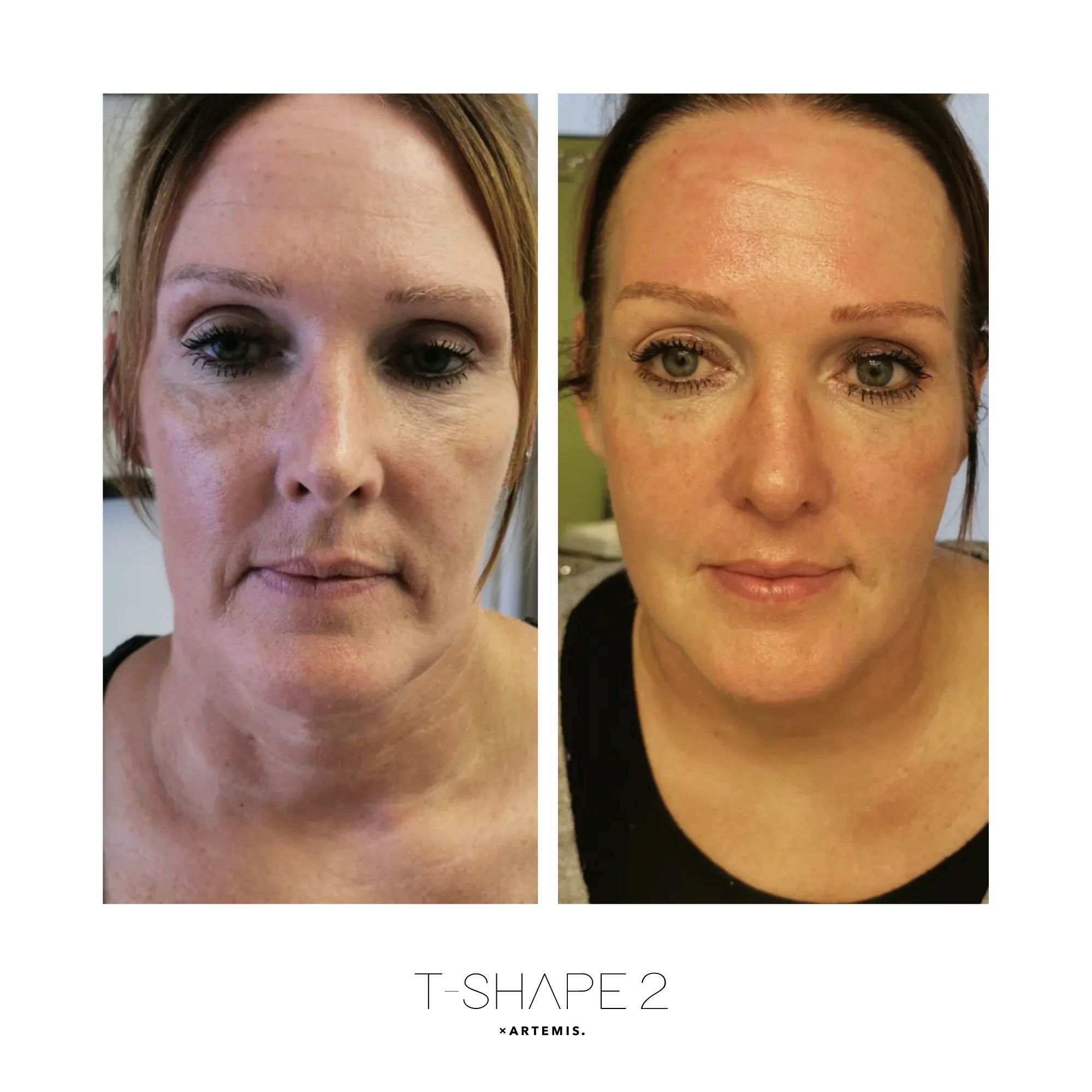 T-Shape 2 results — Face at iCRYO Port St. Lucie