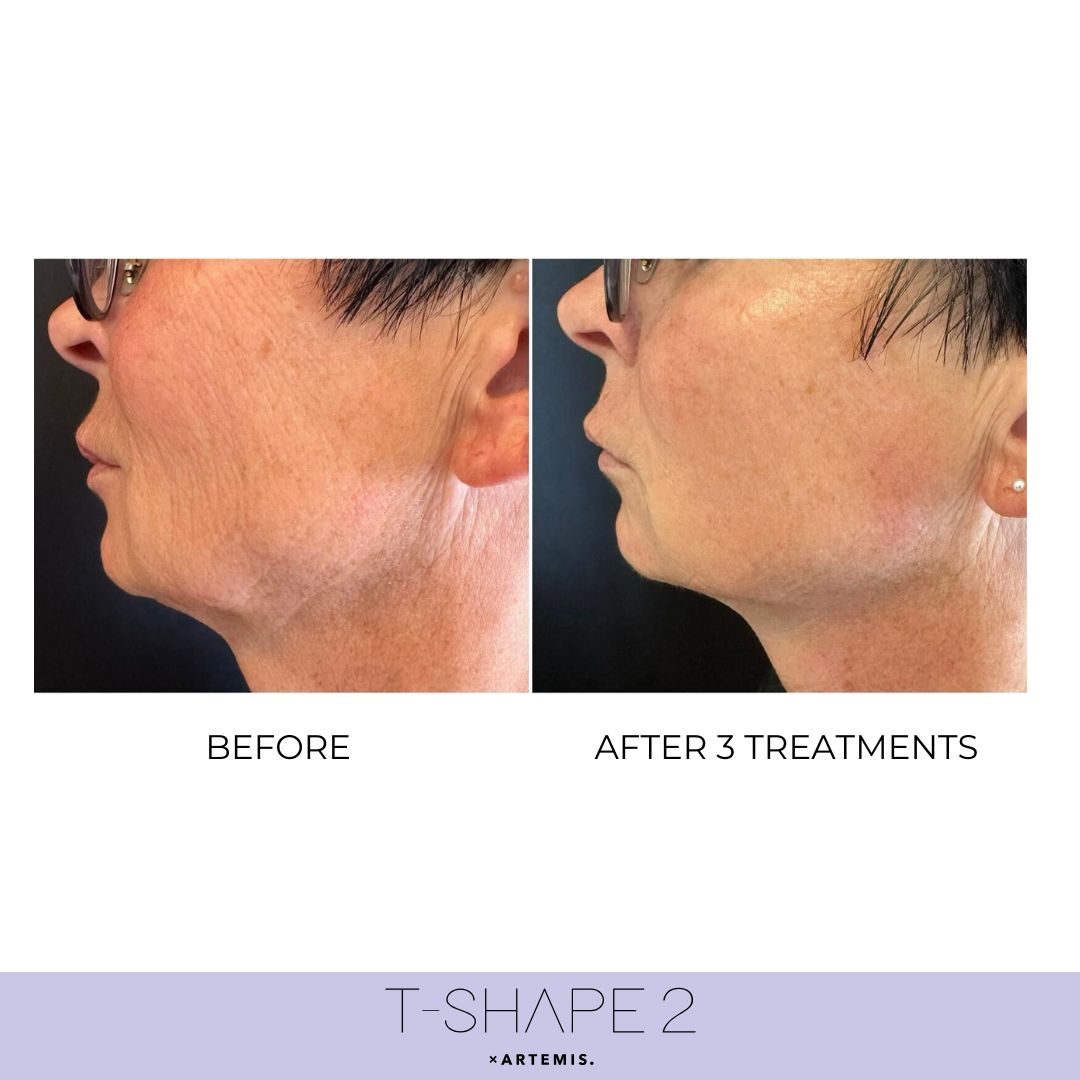 T-Shape 2 results — Neck at iCRYO Port St. Lucie